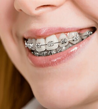 Correct Braces